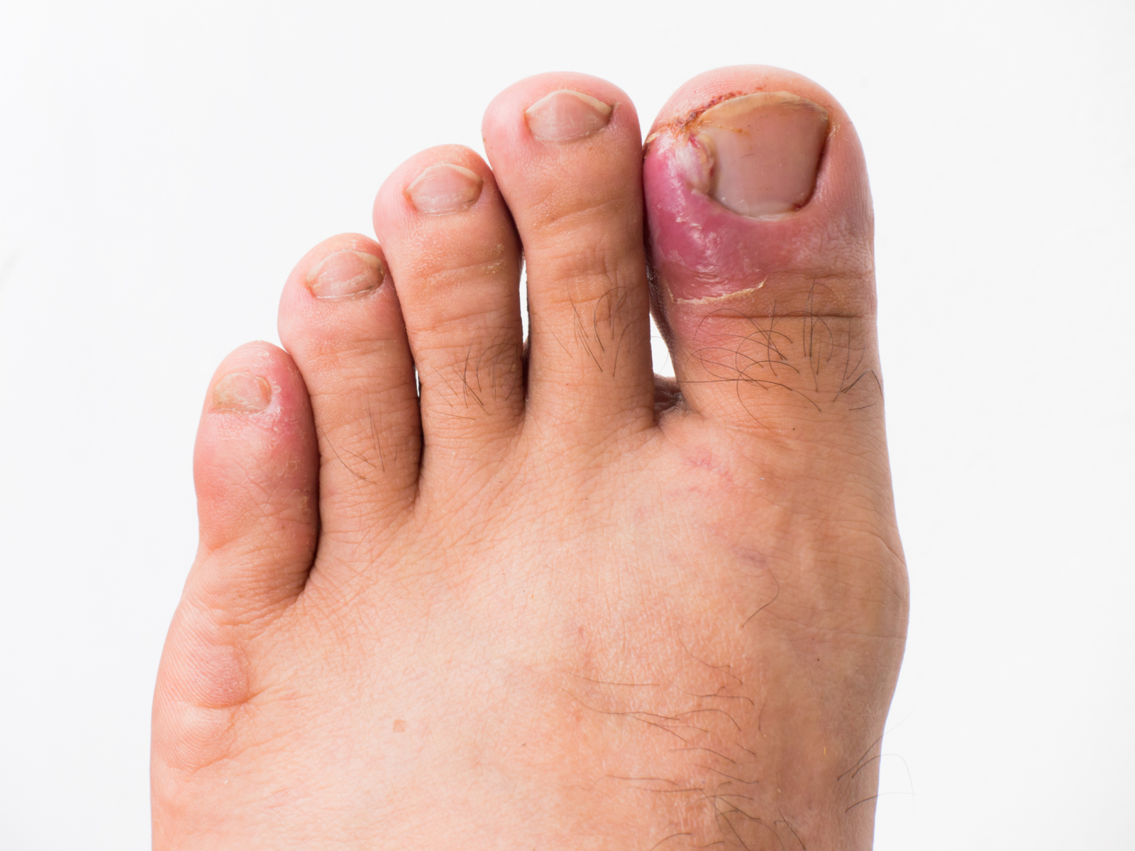 Ingrown Toenail Solutions